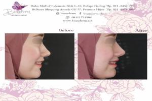 Filler Hidung / Nose Filler